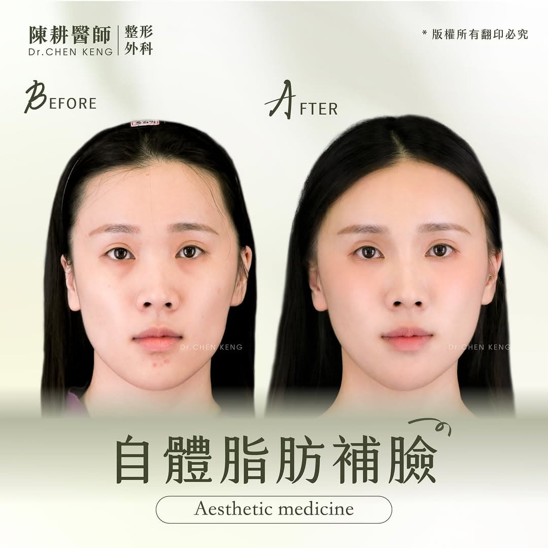 自體脂肪補臉缺點